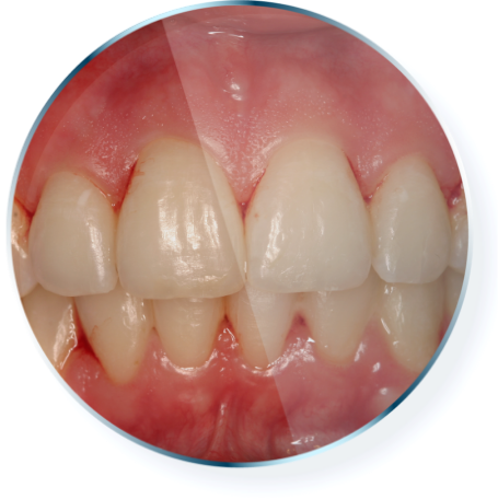 Front teeth and gums